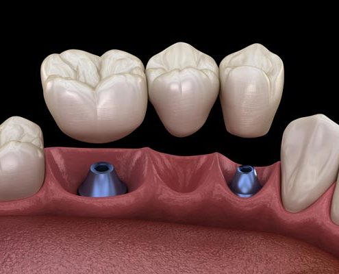 MeinZahnarzt Innsbruck - Zahnimplantate Implantate in Tirol